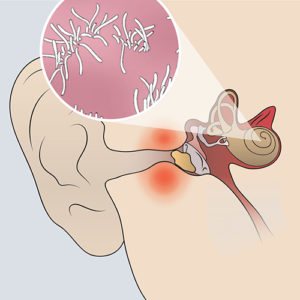 Mixed Hearing Loss